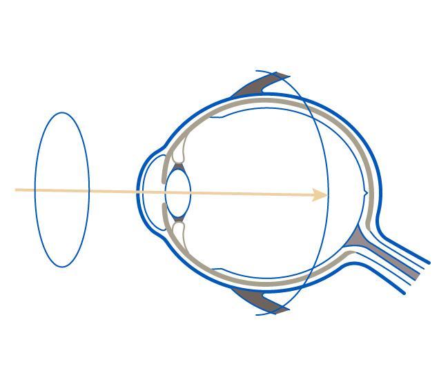 Crecimiento de la longitud axial y prescripción